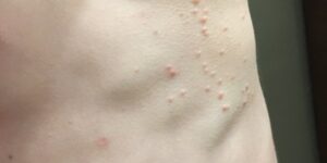 U MỀM LÂY (Molluscum Contagiosum)