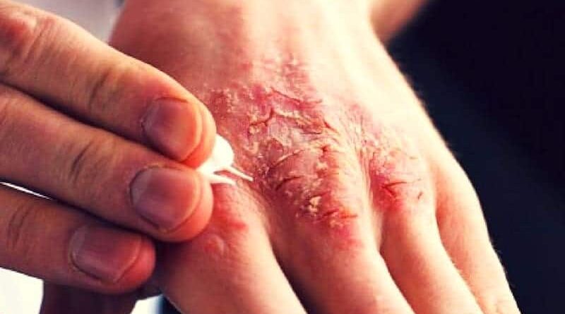 BỆNH GHẺ (Scabies)