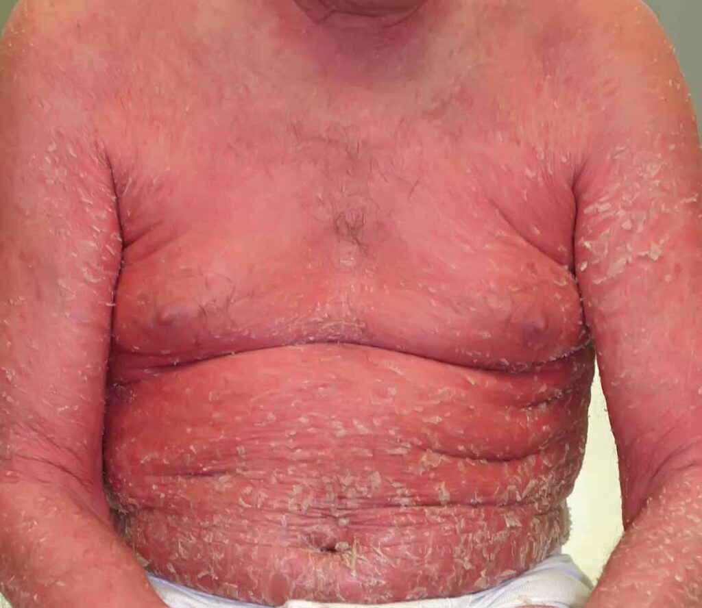 ĐỎ DA TOÀN THÂN (Erythroderma)