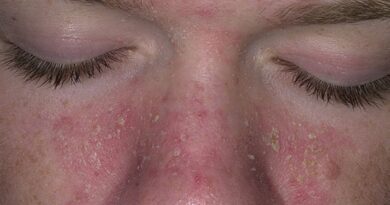 VIÊM DA DẦU (Seborrheic Dermatitis)
