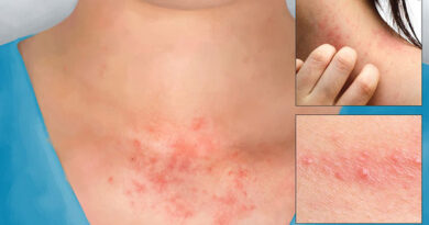 VIÊM DA TIẾP XÚC DỊ ỨNG (Allergic Contact Dermatitis)