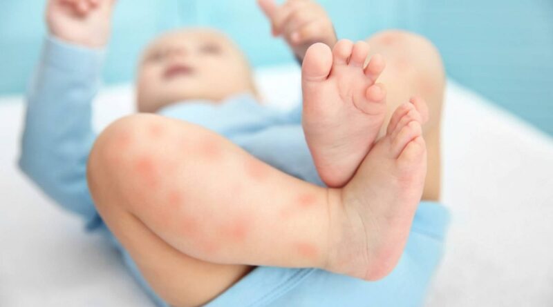 Các bệnh da liễu thường gặp ở trẻ nhỏ